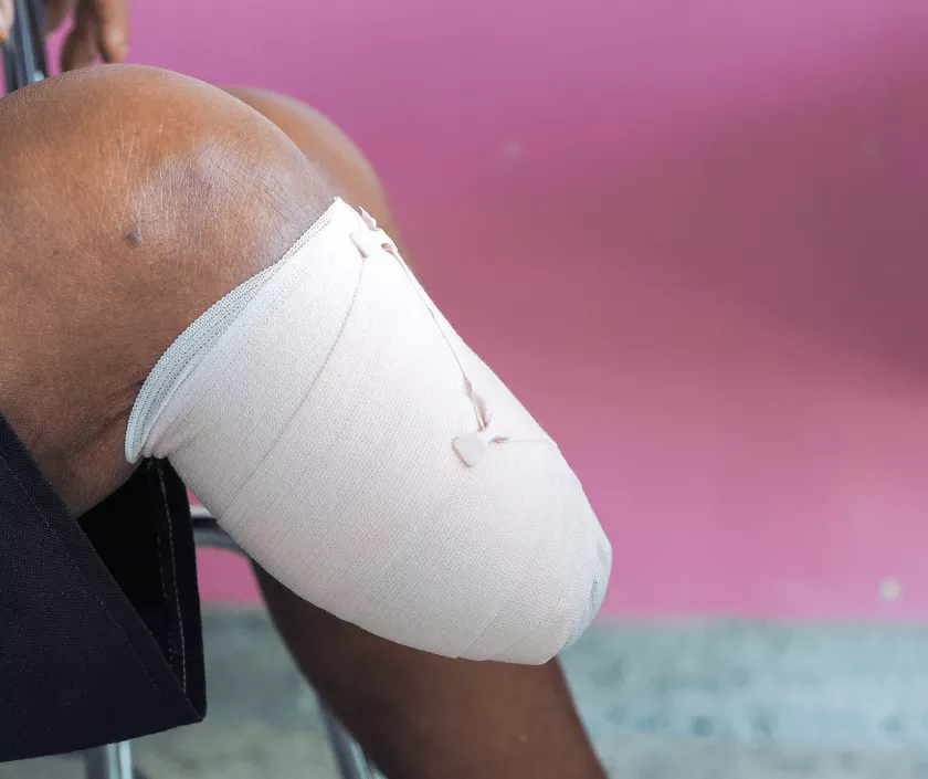 Below Knee Amputation