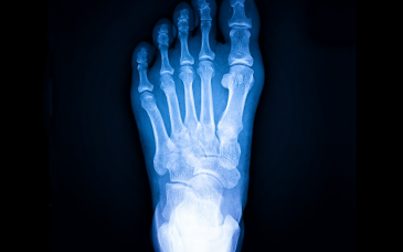 Bone Scan