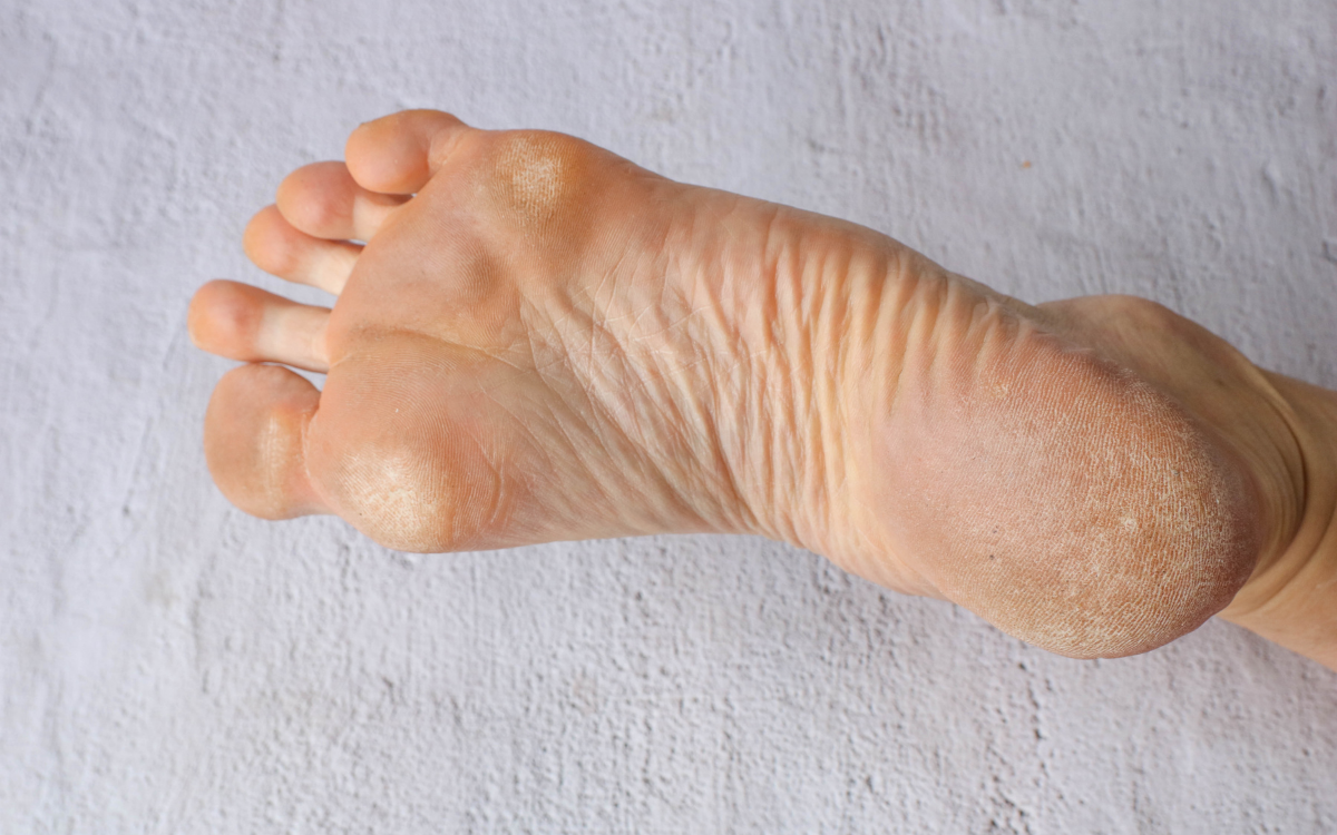 Callus Management
