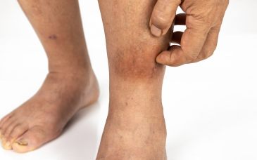 Cellulitis / Abscess Management