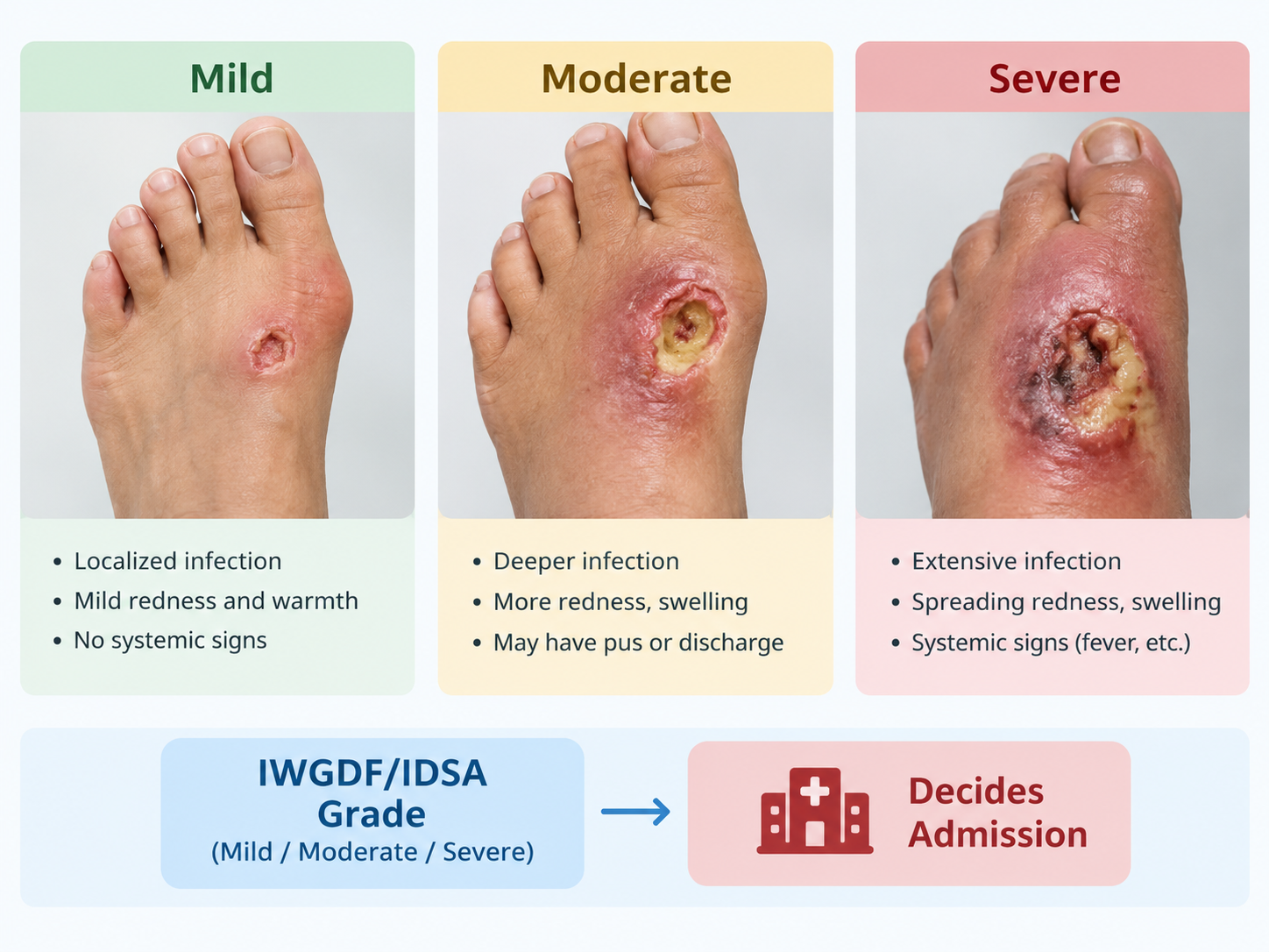 Mild, Moderate or Severe Diabetic Foot Infection: The IWGDF/IDSA Grade That Decides Admission