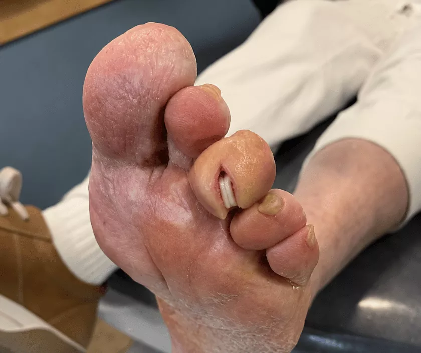 flexor-tenotomy