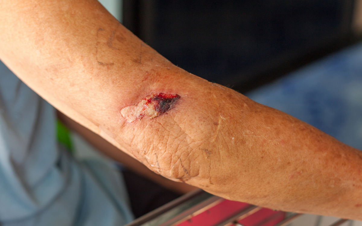 Moist Wound Healing at Elegance Diabetic Foot & Ulcer Clinic