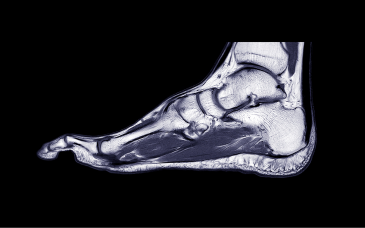 MRI Foot