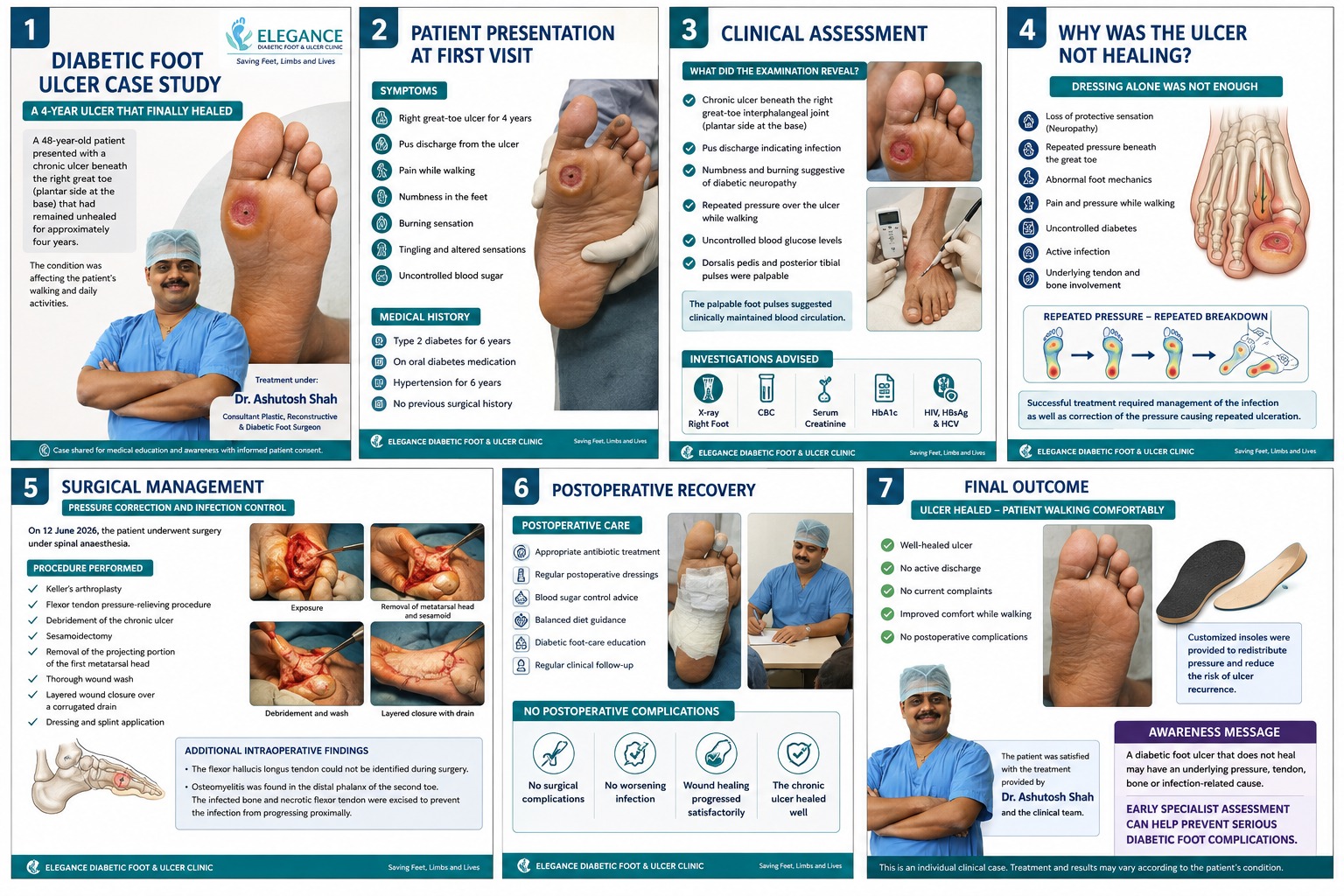 Diabetic Foot Ulcer Case Study: A 4-Year Ulcer That Finally Healed