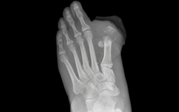 Osteomyelitis Management