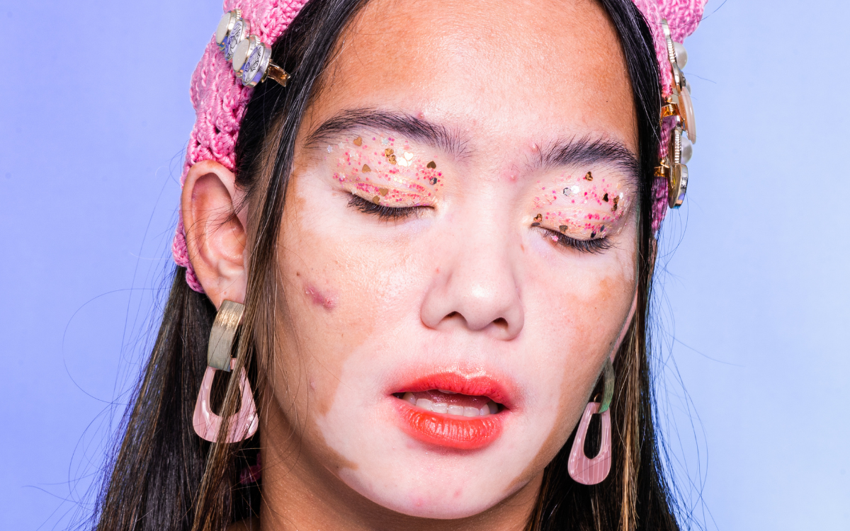 Skin Discoloration