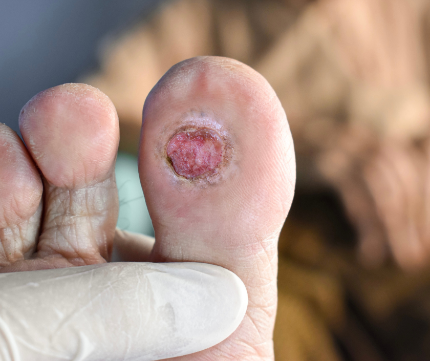 Ulcer Assessment