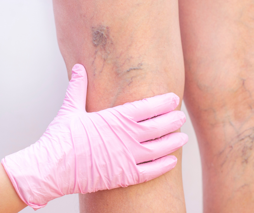 Vascular Assessment