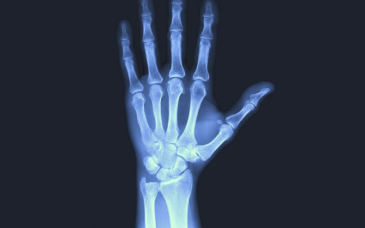 X-rays