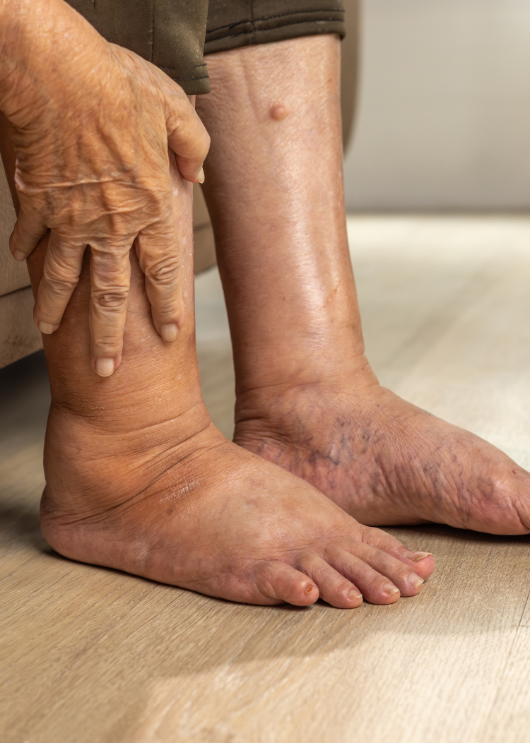 Advanced care for diabetic foot disorders in Surat
