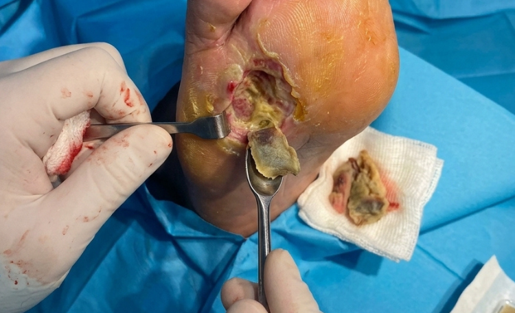 Advanced diabetic foot surgery in Surat