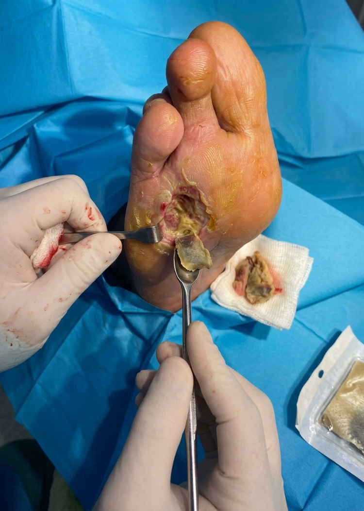 Advanced diabetic foot surgery in Surat