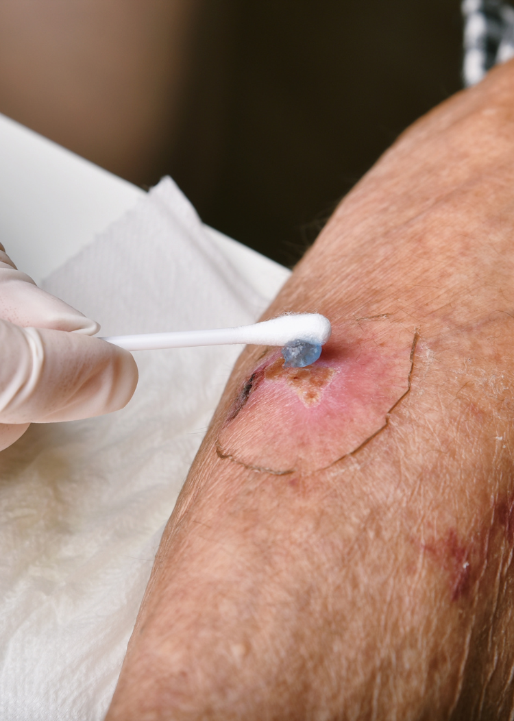 Non-surgical treatment for diabetic foot ulcers