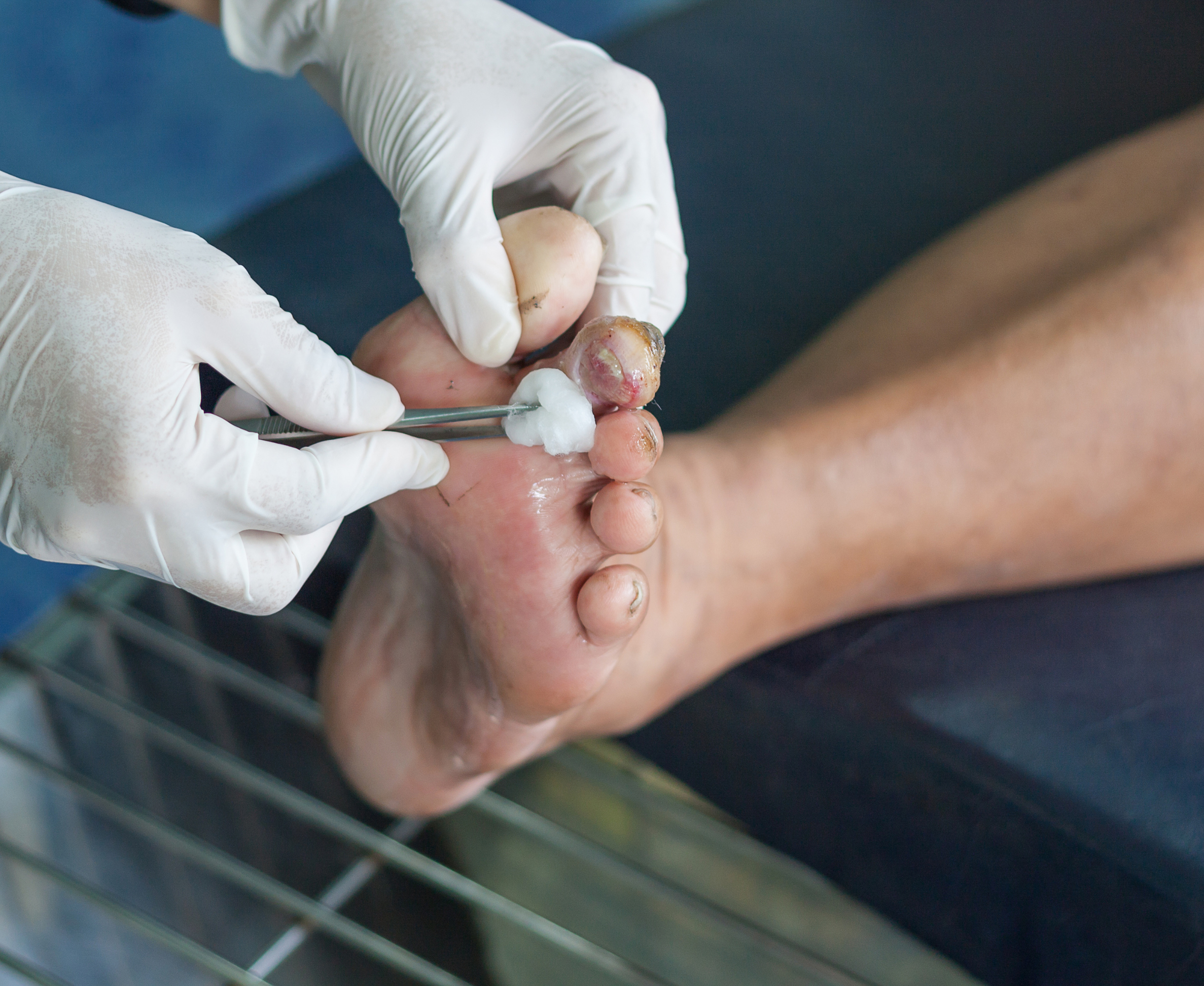 Elegance diabetic foot and ulcer Clinic Adajan