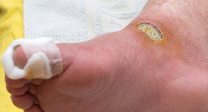 Diabetic Foot Treatment in Surat