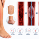 catheter leg clot
