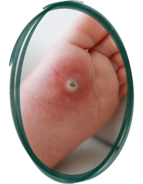 why choose us for Advanced diabetic foot treatment